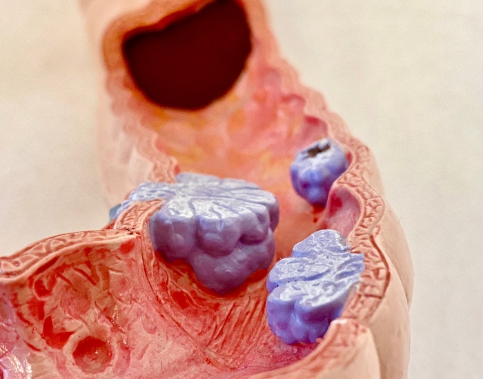 colon cancer screening Houston